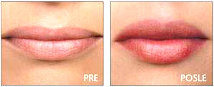 Perfect Pout SKIN DOCTORS (8ml) - dodatni pogled
