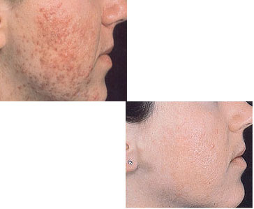 Acnaquit gel 50ml - dodatni pogled