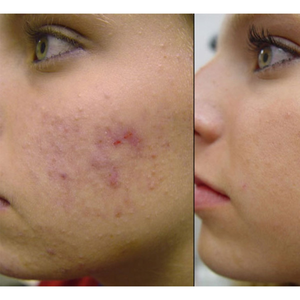 Antiac sprej protiv akni, plikova, mitesera, crvenila 50ml - dodatni pogled