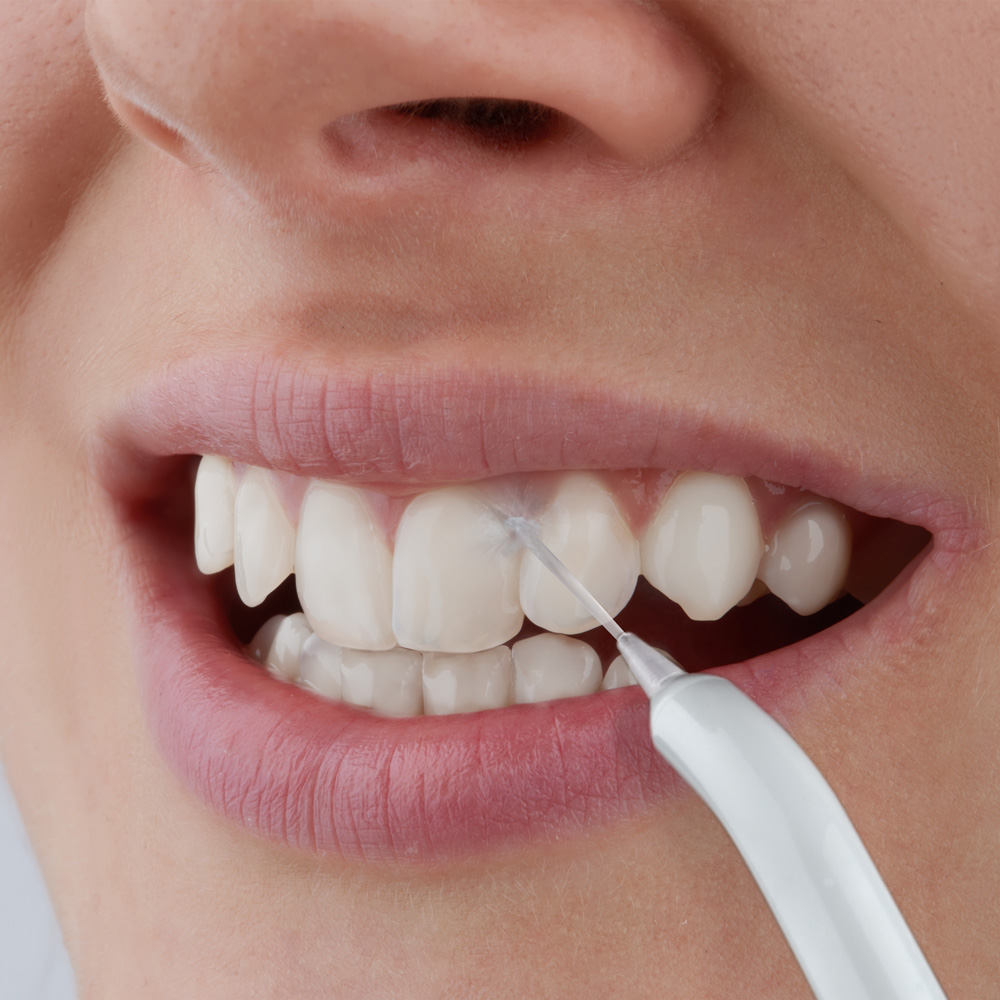 SENCOR Oralni tuš za zube SOI 3312WH - detalj