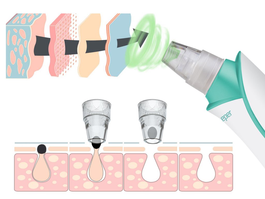 Aparat za čišćenje pora i uklanjanje mitisera BEPER P302VIS001 - detalj