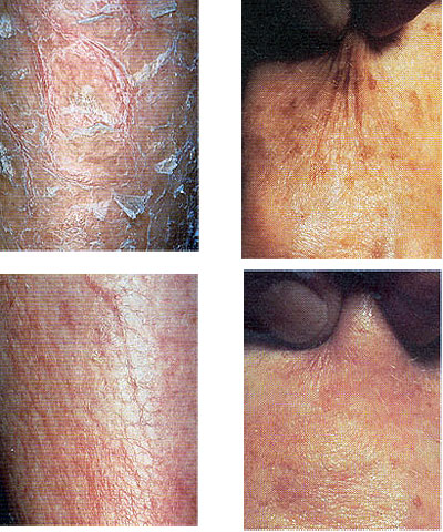 Antiekcem krem sa susamovim uljem 50ml - detalj