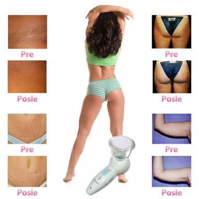 Celluless - Anticelulit masažer za vidno smanjenje celulita